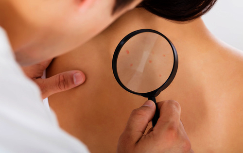 Jak wygląda rak skóry i jak go rozpoznać?