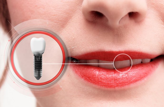 Czy implanty zębów są dla Ciebie? Sprawdź, kiedy zabiegi implantologiczne nie są wskazane