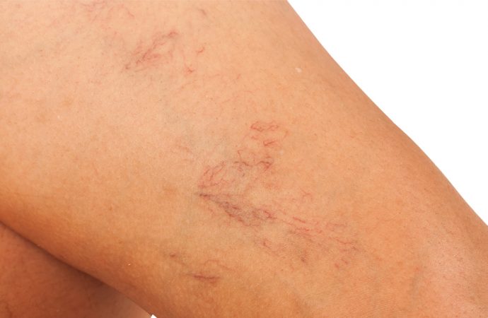 Pielęgnacja skóry naczyniowej – jak o nią dbać?