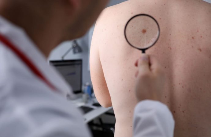 Rak skóry – jak wygląda leczenie czerniaka?