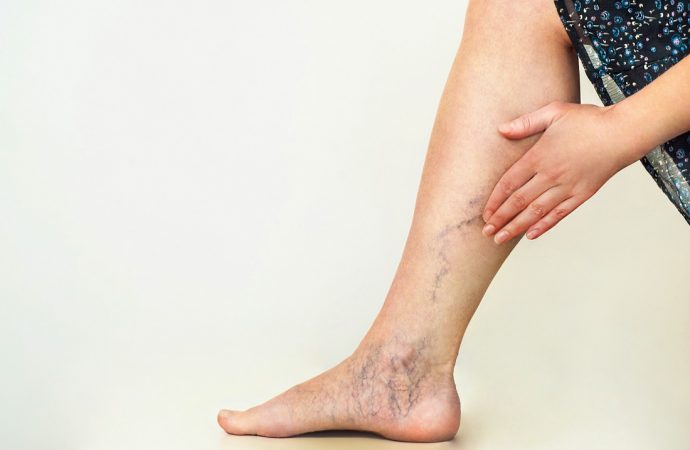 Konsekwencje nieleczonych żylaków nóg